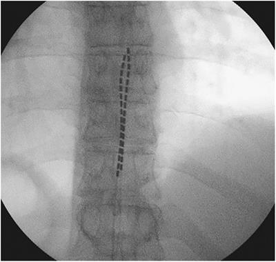 Case report: Spinal cord stimulation for pain relief in two patients with locally recurrent pelvic malignancy